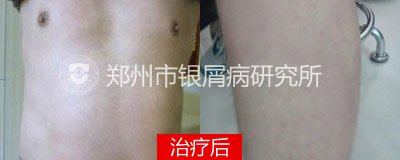 规范治疗,别让牛皮癣阻碍了升迁路