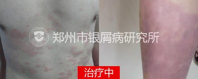 规范治疗,别让牛皮癣阻碍了升迁路