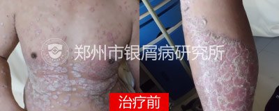 规范治疗,别让牛皮癣阻碍了升迁路