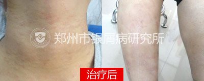 花一般的年纪 怎能让牛皮癣兴风作浪
