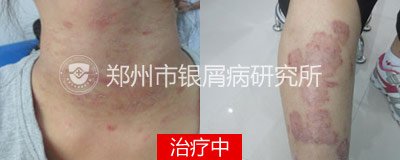 花一般的年纪 怎能让牛皮癣兴风作浪