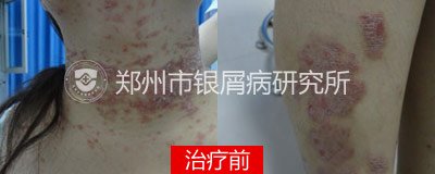 花一般的年纪 怎能让牛皮癣兴风作浪